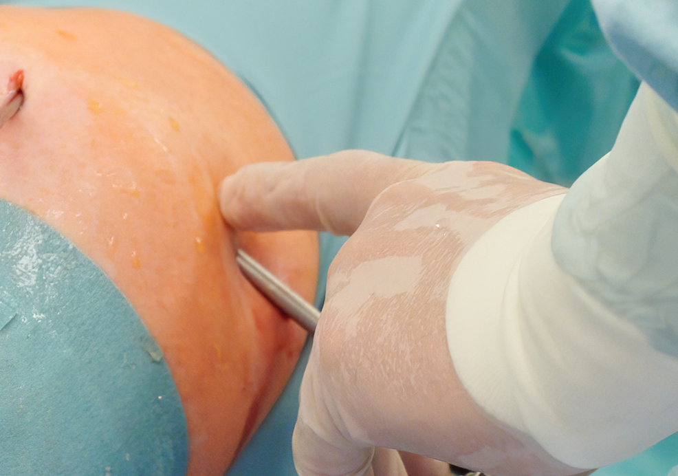 OPERACJE ORTOPEDYCZNE BARKU